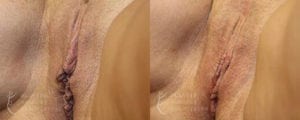 Patient 1b Vaginal Rejuvenation Before and After