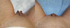 Patient 2b Vaginal Rejuvenation Before and After