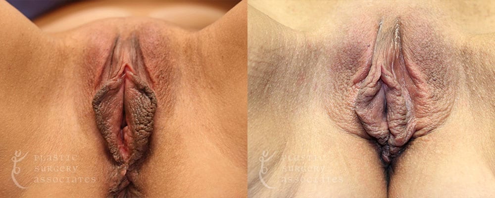 Patient 3 Vaginal Rejuvenation Before and After