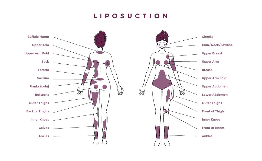 What Areas of the Body Can Liposuction Treat? - Cosmos Clinic