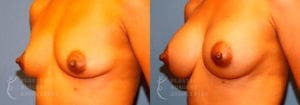 Patient 10b Breast Augmentation Before and After