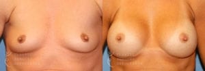 Patient 11a Breast Augmentation Before and After