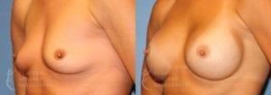 Patient 11b Breast Augmentation Before and After