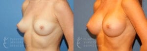 Patient 12b Breast Augmentation Before and After