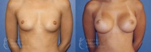 Patient 13a Breast Augmentation Before and After