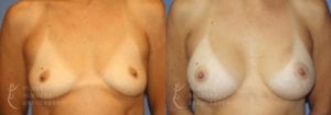 Patient 15a Breast Augmentation Before and After