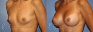 Patient 17b Breast Augmentation Before and After