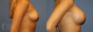 Patient 18b Breast Augmentation Before and After