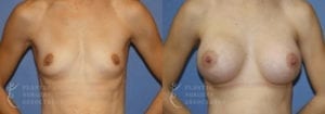 Patient 19a Breast Augmentation Before and After