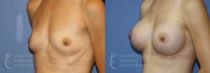 plastic-surgery-associates-san-francisco-breast-augmentation-patient-19-2