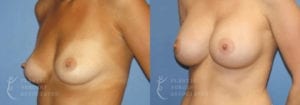 Patient 20b Breast Augmentation Before and After