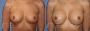 Patient 21a Breast Augmentation Before and After