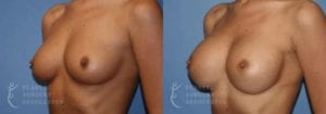 Patient 21b Breast Augmentation Before and After