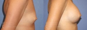 Patient 23b Breast Augmentation Before and After