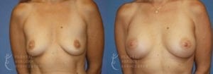Patient 24a Breast Augmentation Before and After