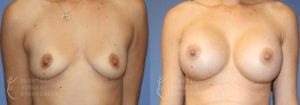 Patient 25a Breast Augmentation Before and After