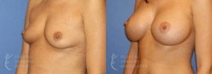 Patient 26b Breast Augmentation Before and After