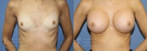 Patient 27a Breast Augmentation Before and After