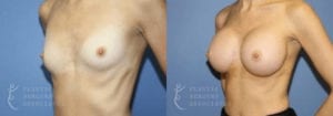 Patient 27b Breast Augmentation Before and After