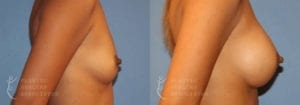 Patient 28b Breast Augmentation Before and After