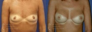 Patient 29a Breast Augmentation Before and After