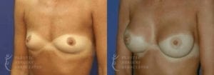 Patient 29b Breast Augmentation Before and After