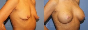 Patient 3b Breast Augmentation Before and After