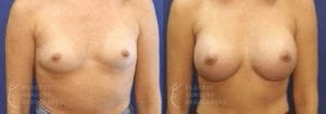 Patient 30a Breast Augmentation Before and After
