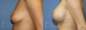 Patient 31b Breast Augmentation Before and After