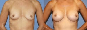 Patient 34a Breast Augmentation Before and After