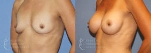 Patient 34b Breast Augmentation Before and After
