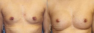 Patient 36a Breast Augmentation Before and After