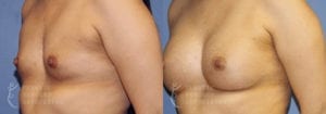 Patient 36b Breast Augmentation Before and After