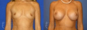 Patient 37a Breast Augmentation Before and After