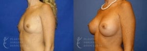 Patient 37b Breast Augmentation Before and After
