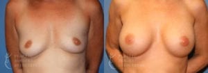 Patient 38a Breast Augmentation Before and After