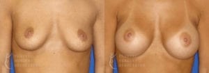 Patient 39a Breast Augmentation Before and After