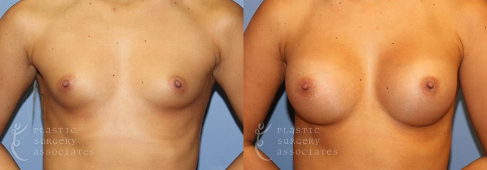 Patient 4a Breast Augmentation Before and After