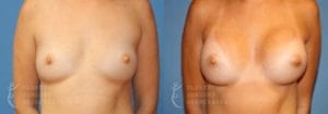 Patient 40a Breast Augmentation Before and After