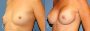 Patient 40b Breast Augmentation Before and After