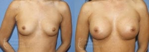Patient 41a Breast Augmentation Before and After