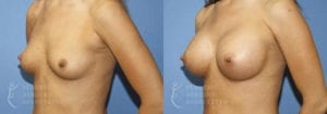 Patient 41b Breast Augmentation Before and After