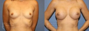 Patient 42a Breast Augmentation Before and After