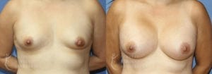 Patient 43a Breast Augmentation Before and After