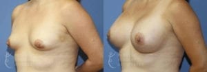 Patient 43b Breast Augmentation Before and After