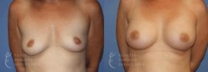 Patient 46a Breast Augmentation Before and After