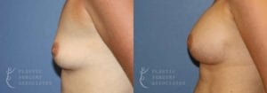Patient 46b Breast Augmentation Before and After