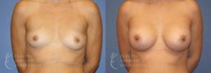 Patient 47a Breast Augmentation Before and After