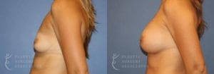 Patient 47b Breast Augmentation Before and After