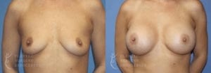 Patient 48a Breast Augmentation Before and After